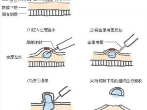 人体无用副组织群体环绕切割术：一种现代医学精细手术详解